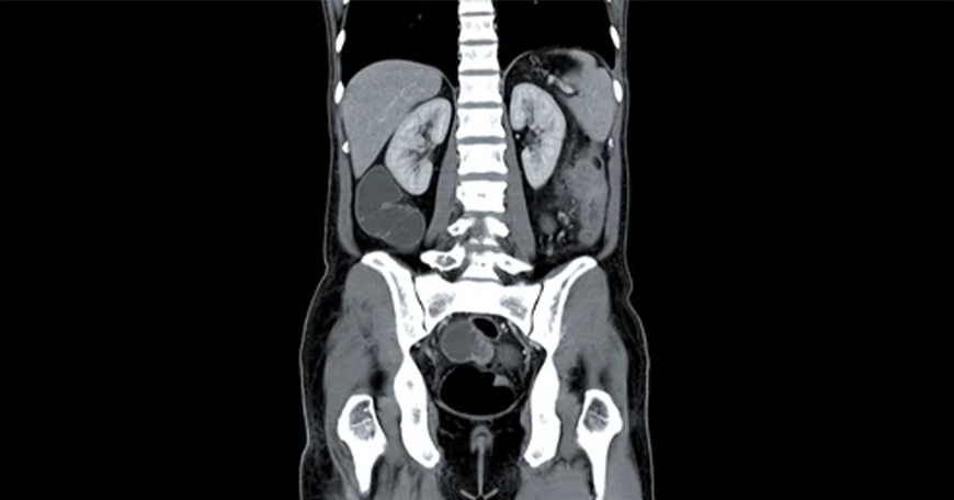 Varicocele Surgery in Mudichur